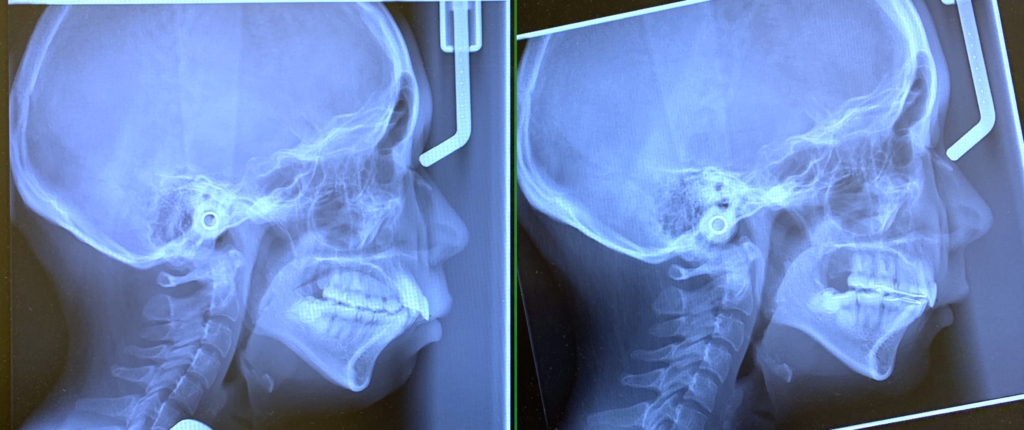 重度の八重歯を伴う乱ぐいの歯並びと口ゴボの人の頭蓋骨を横から見たレントゲン写真（矯正前と矯正後の比較）
