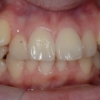 重度の八重歯を伴う乱ぐいの歯並び（矯正前）