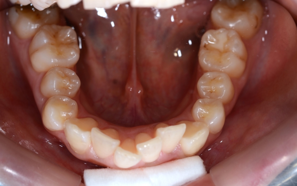 重度の八重歯を伴う乱ぐいの歯並び（矯正前）