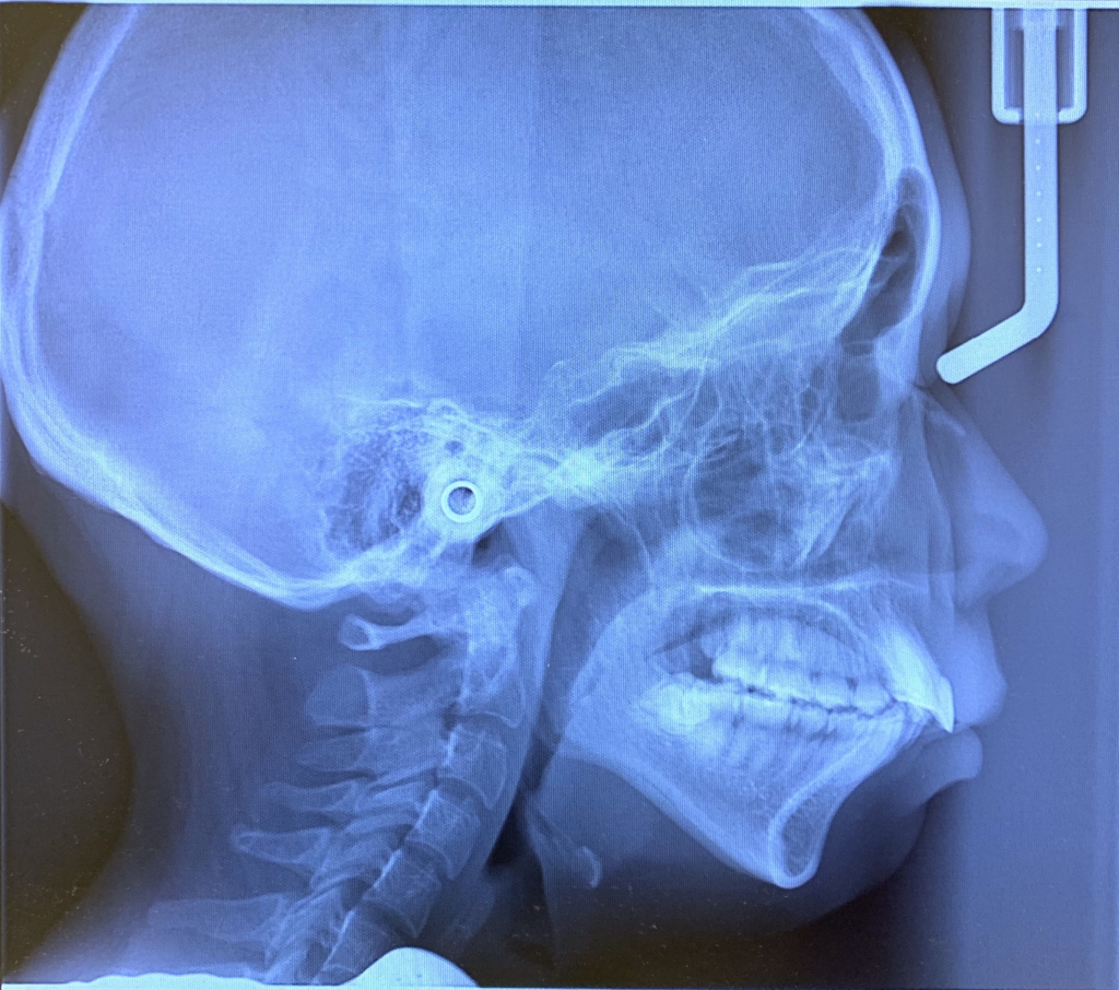 重度の八重歯を伴う乱ぐいの歯並びと口ゴボの人の矯正前の頭蓋骨を横から見たレントゲン写真