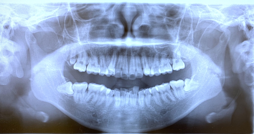 重度の八重歯を伴う乱ぐいの歯並びの顎全体のレントゲン写真