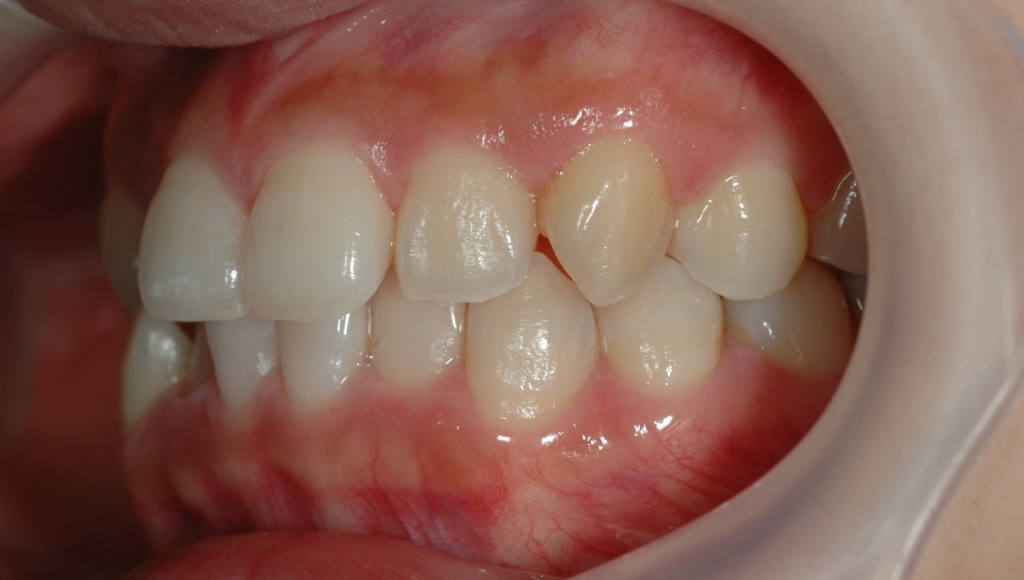 叢生の歯並び（矯正治療前）