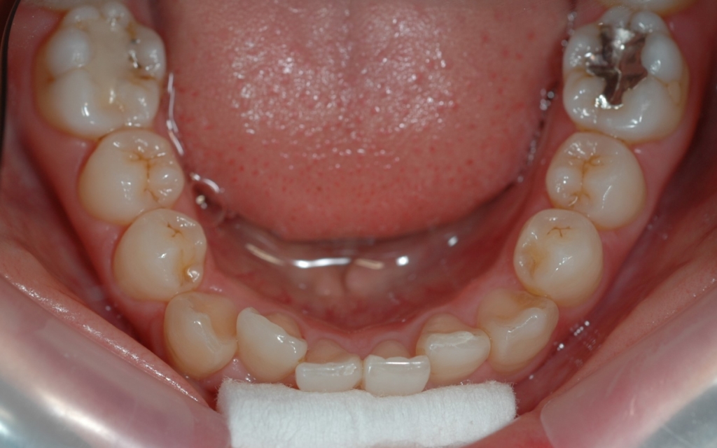 叢生の歯並び（矯正治療前）