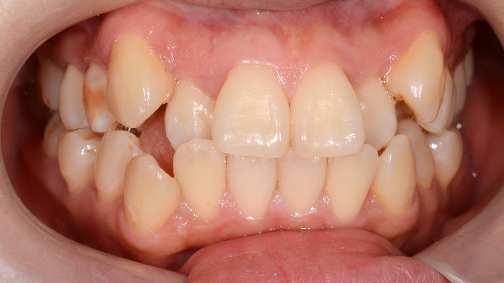 八重歯（叢生）の歯並び
