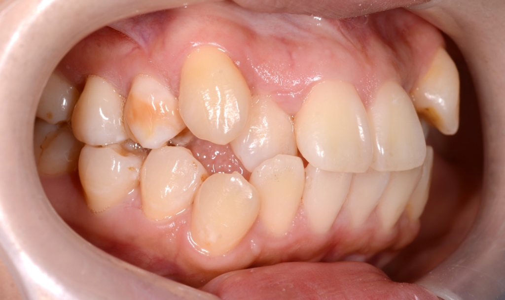 八重歯（叢生）の歯並び