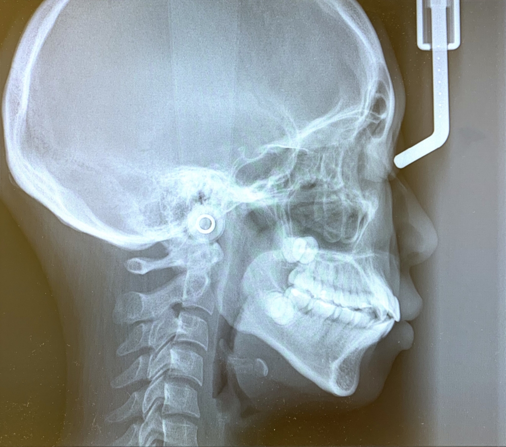 八重歯（叢生）の歯並びの人の頭蓋骨を横から見たレントゲン写真