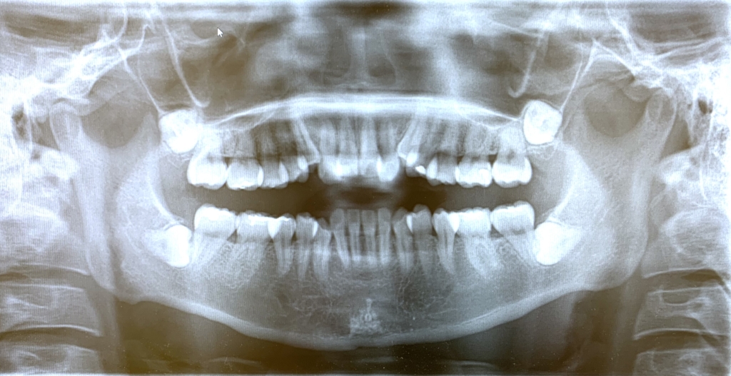 八重歯（叢生）の歯並びの顎全体のレントゲン写真