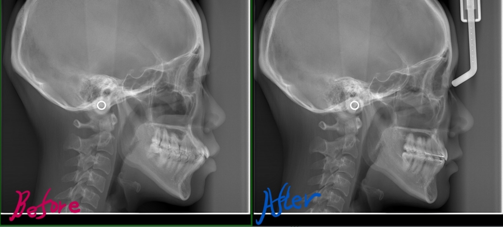 左側が矯正治療前、右側が矯正治療後のレントゲン写真です