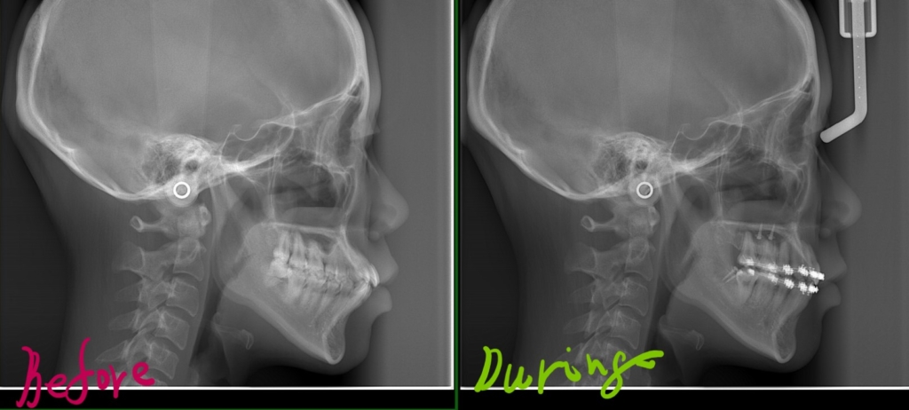 左側が矯正前、右側が矯正途中(抜歯分のスペースを使い切った状態)のレントゲン写真です
残念ですが、口元はあまり明確な変化は見られません