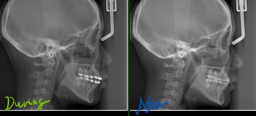 左側が矯正治療途中(抜歯分のスペースを使い切った状態)、右側が矯正治療後のレントゲン写真です