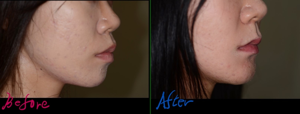 左側が矯正治療前、右側が矯正治療後の横顔と口元です