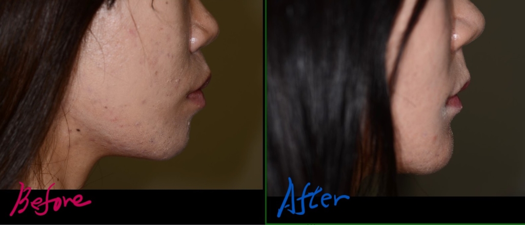 左側が矯正前の口元、右側が矯正後の口元、です。