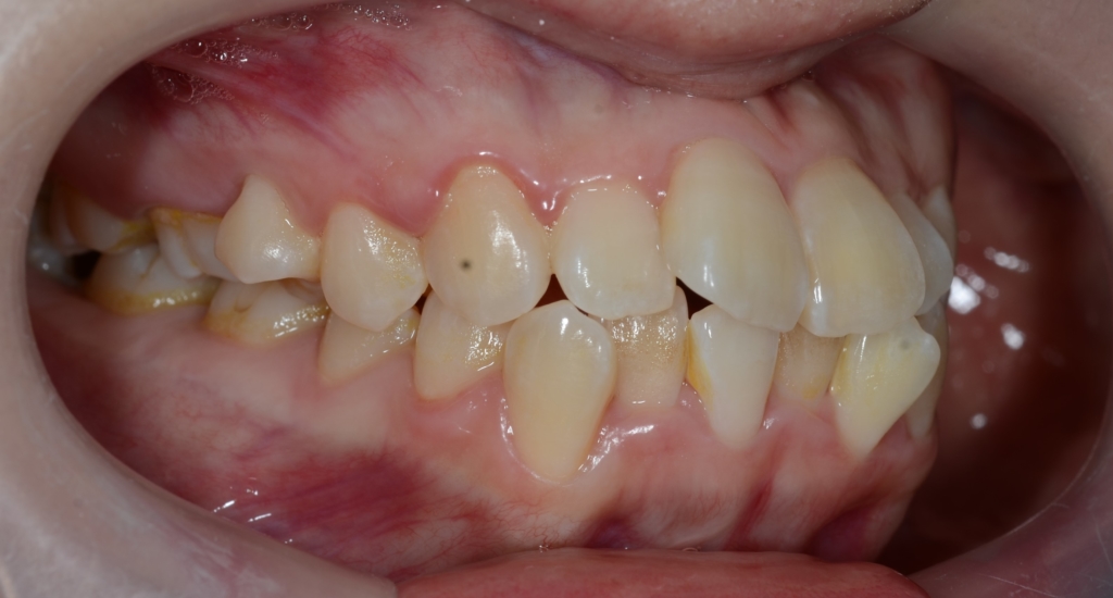 口ごぼを矯正する前の叢生を伴う歯並び