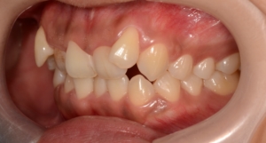 八重歯（叢生）の矯正前の歯並び