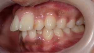 叢生の矯正前の歯並び