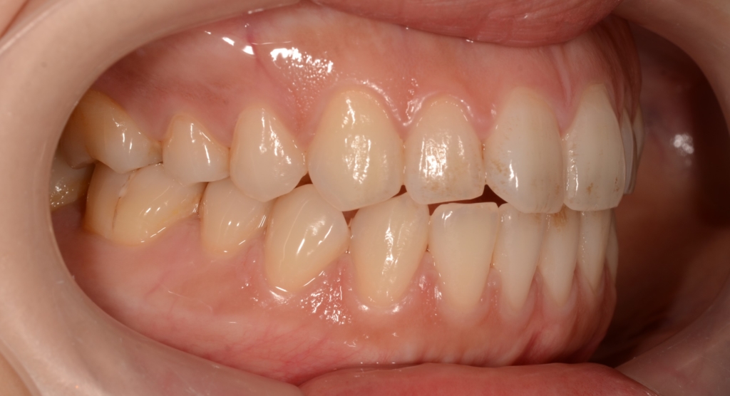 ガミースマイルを伴うごぼ口の人の矯正前の歯並び