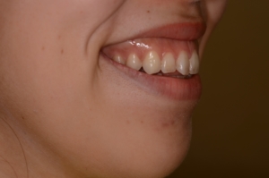 ガミースマイルを伴うごぼ口の人の矯正前の歯ぐきが大きく見える笑顔