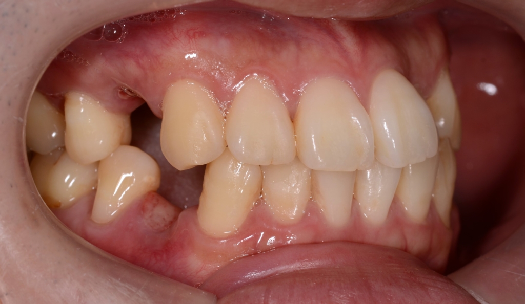 口元が出ているごぼ口の人の矯正前の歯並び
