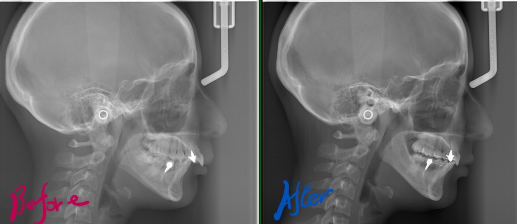 叢生を伴う出っ歯の矯正治療前後のレントゲン写真の比較です