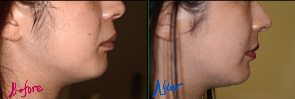 叢生を伴う出っ歯の矯正治療前後の横顔と口元の比較です