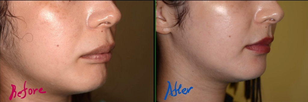 叢生を伴う出っ歯の矯正治療前後の横顔と口元の比較です