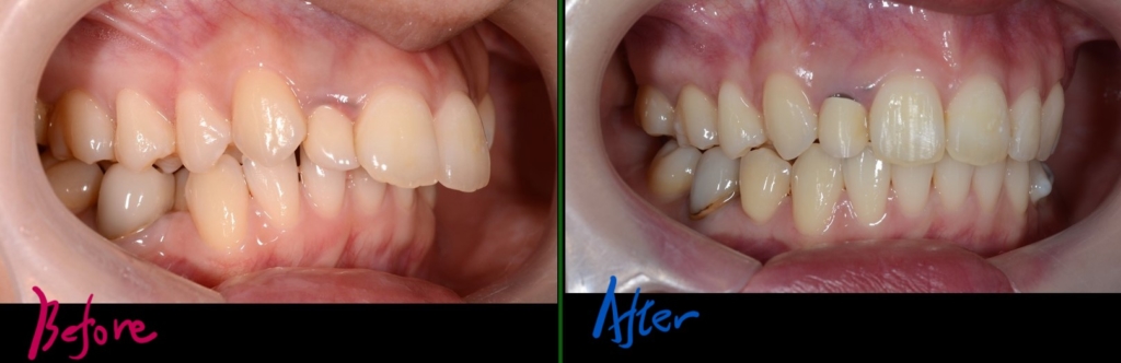 叢生を伴う出っ歯の矯正治療前後の歯並びの比較です