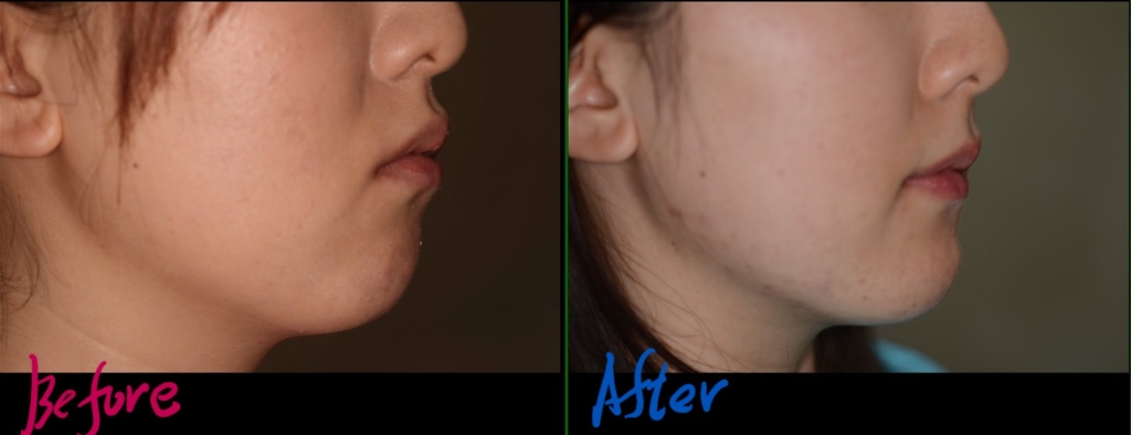 八重歯で開口の矯正治療前後の横顔と口元を比較した写真