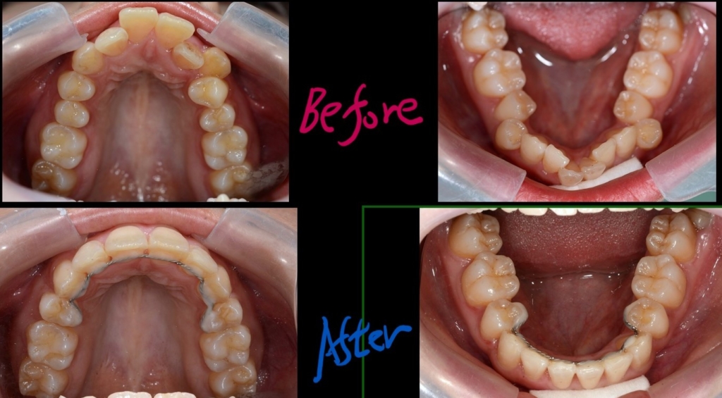 八重歯で叢生を矯正した治療前後の比較
