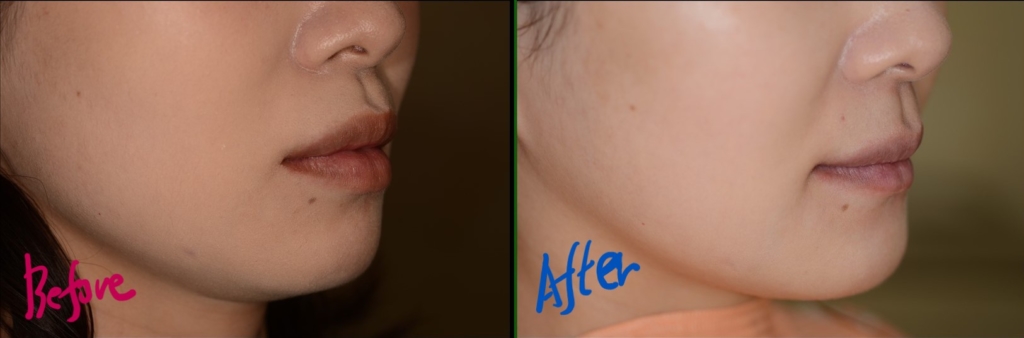 八重歯で口ゴボを矯正した治療前後の横顔と口元の比較