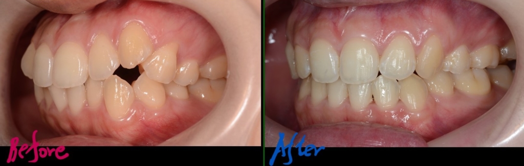 八重歯で口ゴボを矯正した治療前後の歯並びの比較