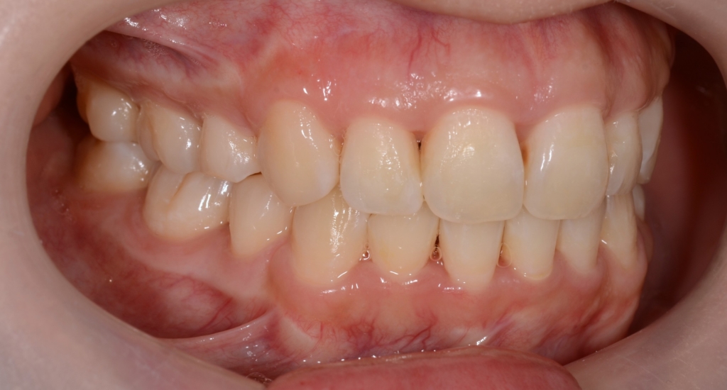 八重歯（叢生）の矯正後の歯並び