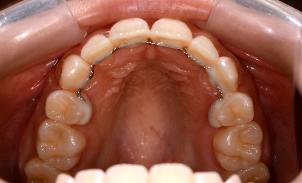 八重歯（叢生）の矯正後の歯並び