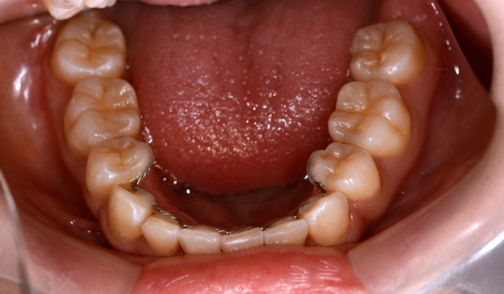 八重歯（叢生）の矯正後の歯並び