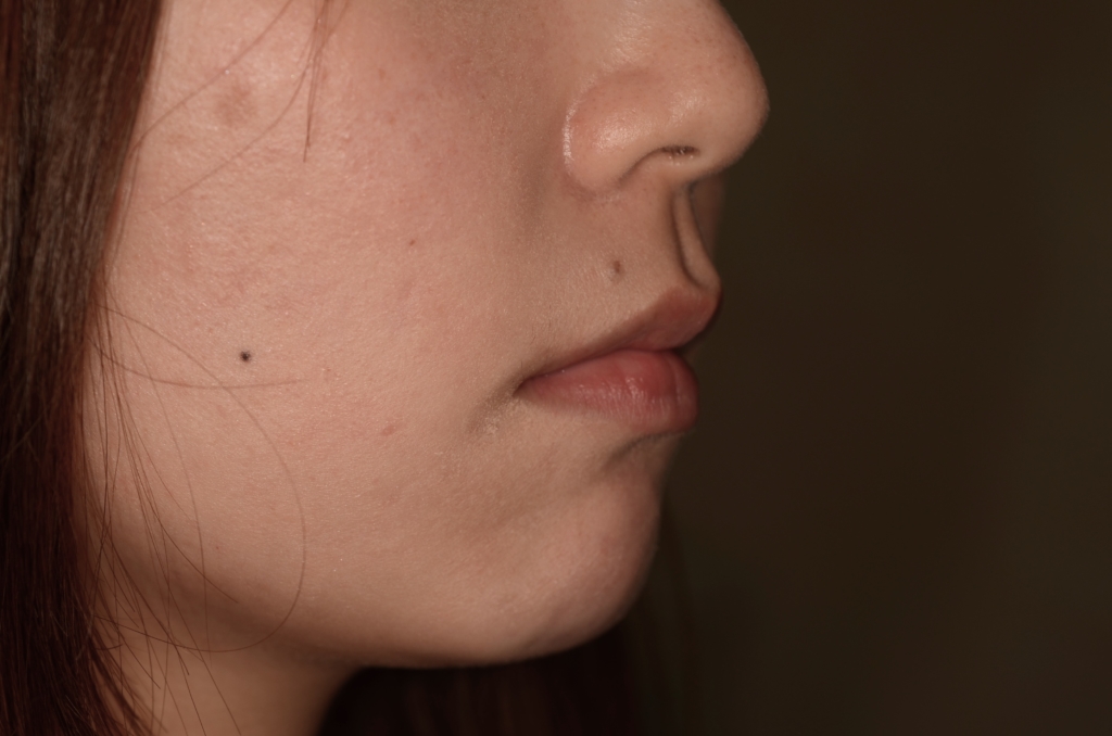 八重歯（叢生）の矯正後の横顔と口元