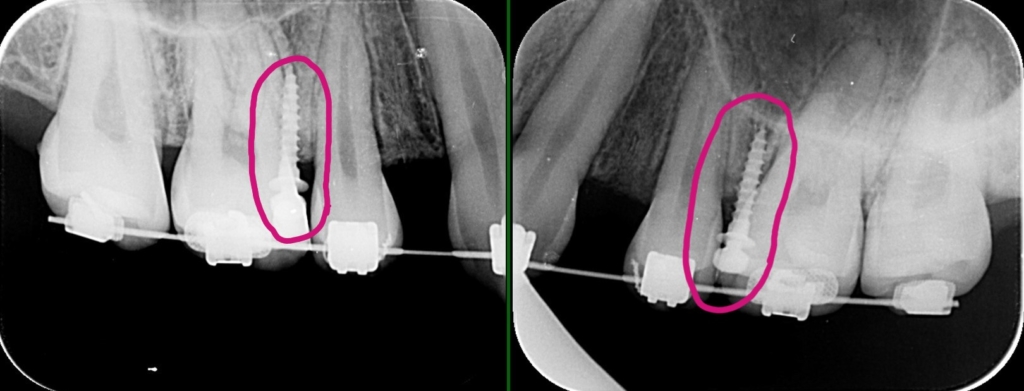 上顎の臼歯部にアンカースクリューを植立