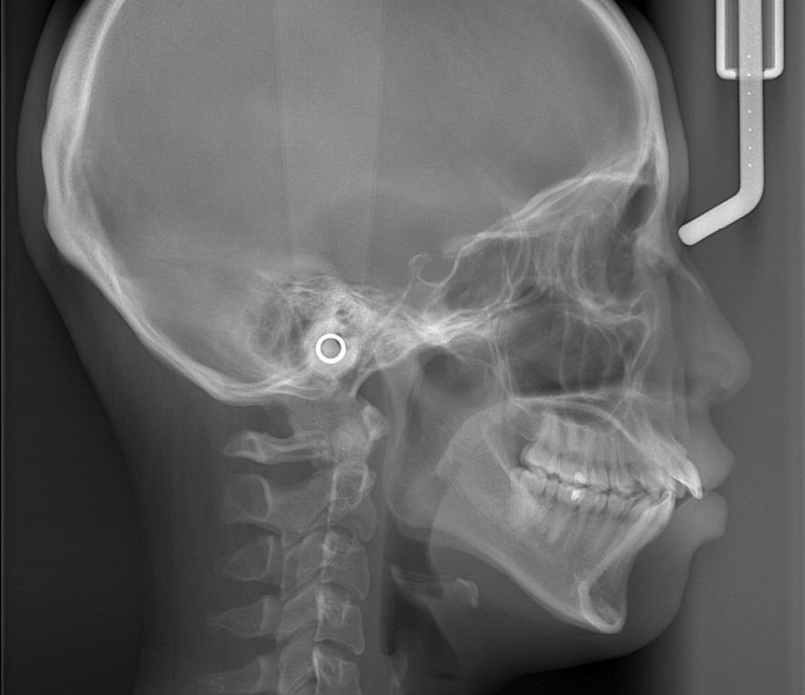 八重歯（叢生）の矯正前の頭部を横から見たレントゲン写真