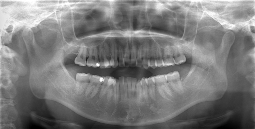 八重歯（叢生）の矯正前の顎全体のレントゲン写真