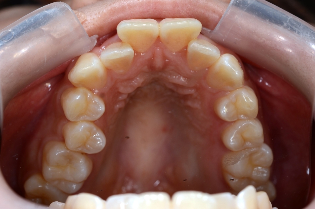八重歯（叢生）の矯正前の歯並び