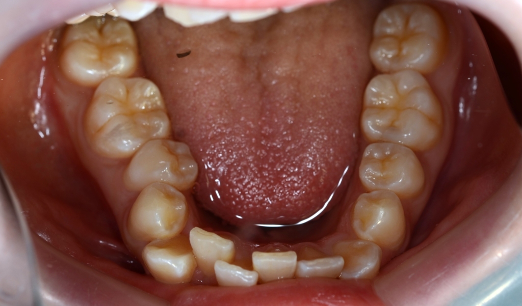八重歯（叢生）の矯正前の歯並び