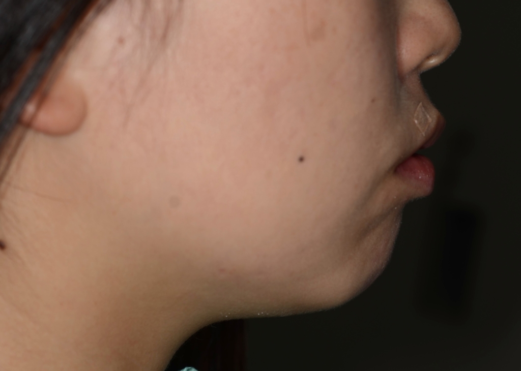 八重歯（叢生）の矯正前の横顔と口元