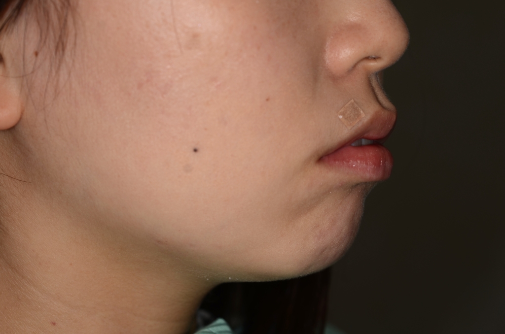 八重歯（叢生）の矯正前の横顔と口元