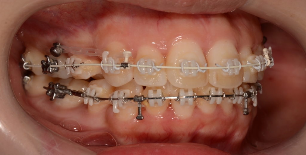 アンカースクリューを併用した矯正治療