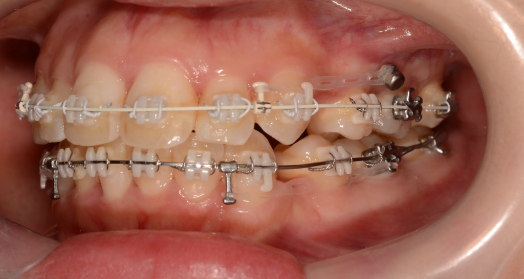 アンカースクリューを併用した矯正治療