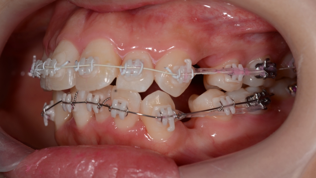 マルチブラケットシステムで矯正治療開始