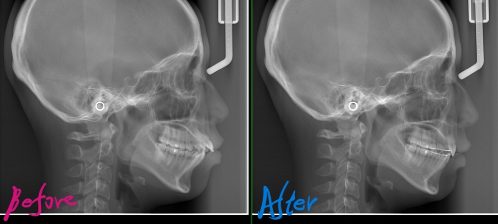 八重歯（叢生）を矯正した治療前後での頭部のレントゲン写真の比較