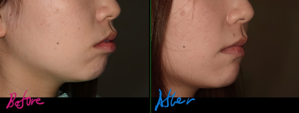 八重歯（叢生）を矯正した治療前後での横顔と口元の比較