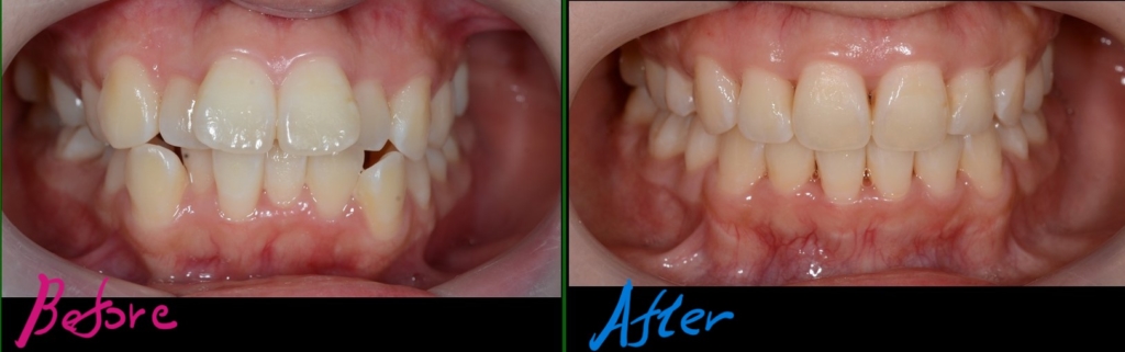八重歯（叢生）を矯正した治療前後での歯並びの比較