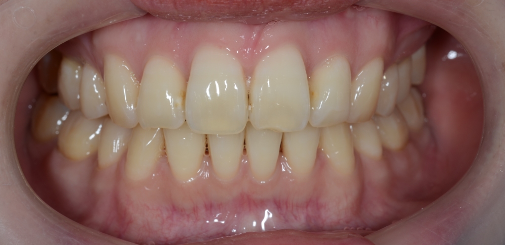 出っ歯でガミースマイルの矯正後の歯並び