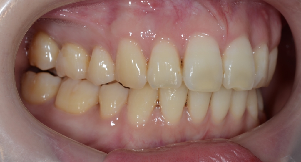 出っ歯でガミースマイルの矯正後の歯並び