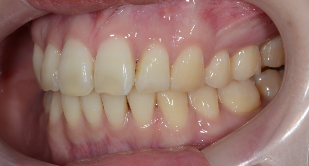 出っ歯でガミースマイルの矯正後の歯並び